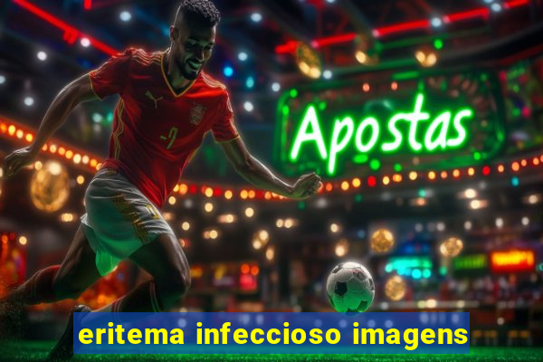 eritema infeccioso imagens